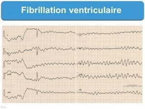 ECG d'une personne atteinte de fibrillation ventriculaire