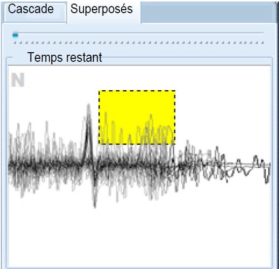 Superposition de l’ensemble des battements du cœur en fonction de leur morphologie.