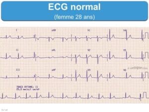 ECG d'une personne normal sans fibrillation