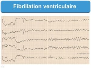 ECG d'une personne atteinte de fibrillation ventriculaire